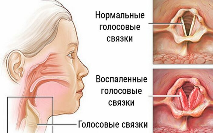 Пропадает голос. Причины, если горло не болит, как лечить