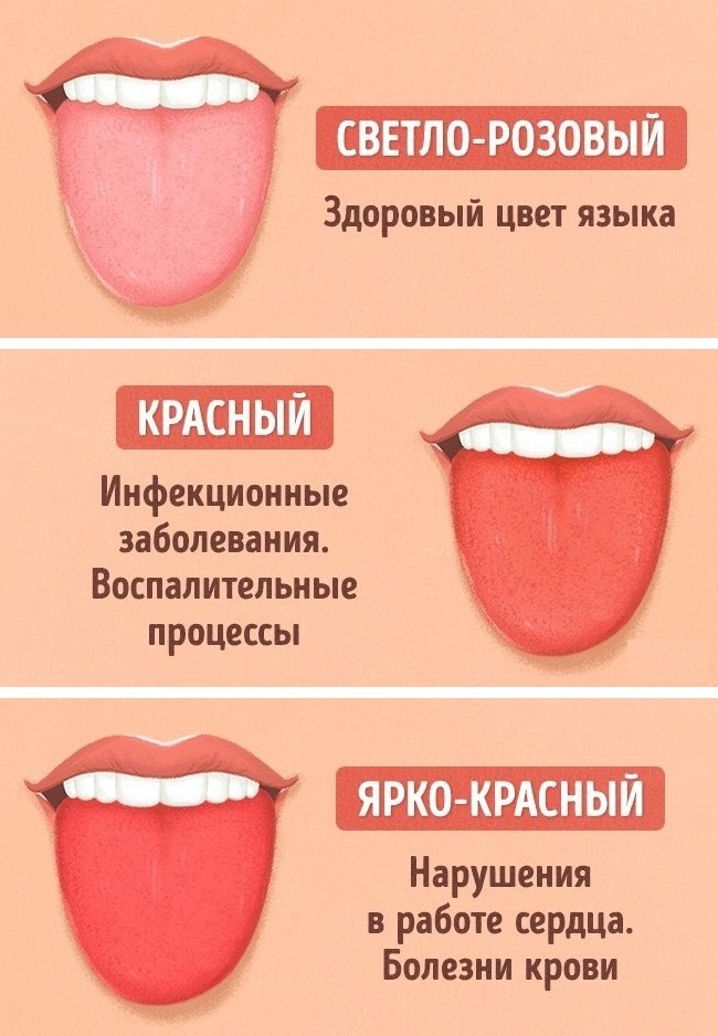 Прыщи на языке. Белый ближе к горлу, под языком, уздечке, красный, сбоку. Причины, чем лечить у взрослого, ребенка