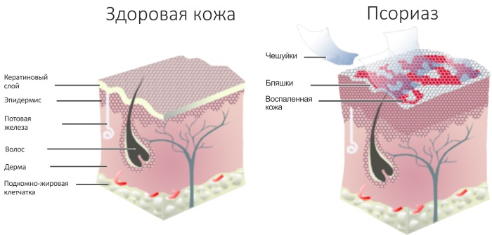 Псориаз. Симптомы и лечение в домашних условиях на голове, теле народными средствами, препараты, мази