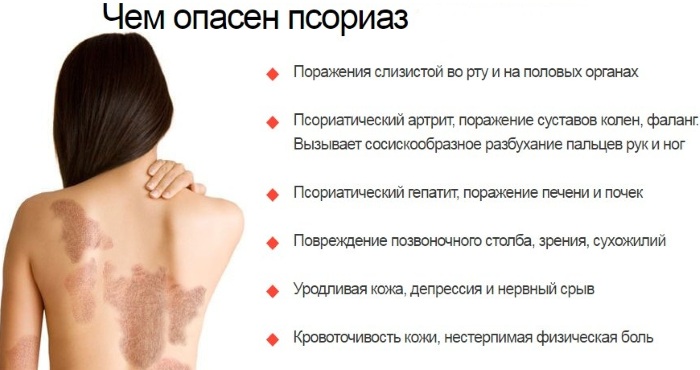 Псориаз. Симптомы и лечение в домашних условиях на голове, теле народными средствами, препараты, мази