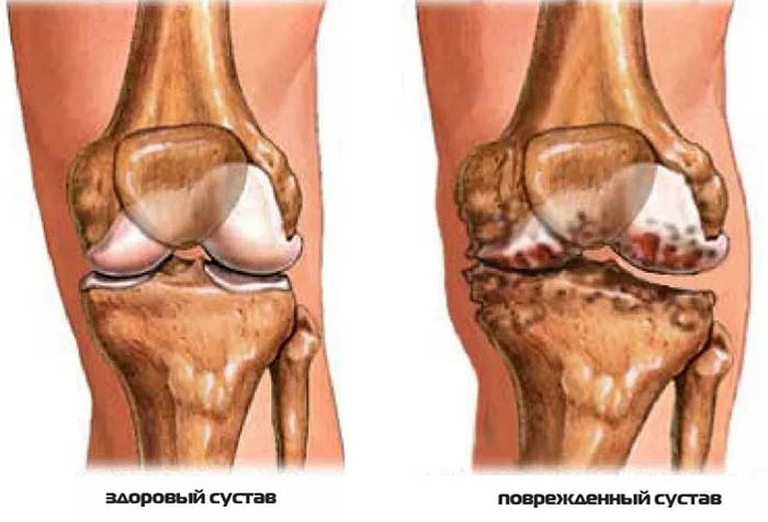 Реактивный артрит. Что это такое, симптомы и лечение