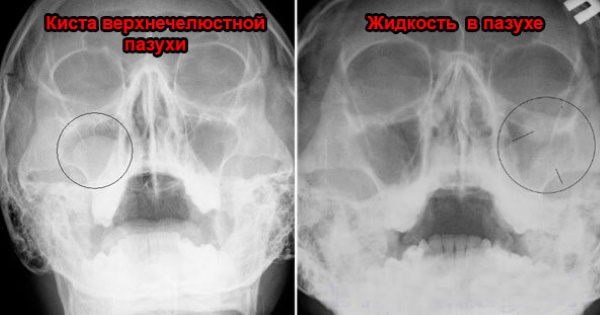 Рентген пазух носа. Что показывает, норма, цена