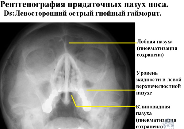 Рентген пазух носа. Что показывает, норма, цена