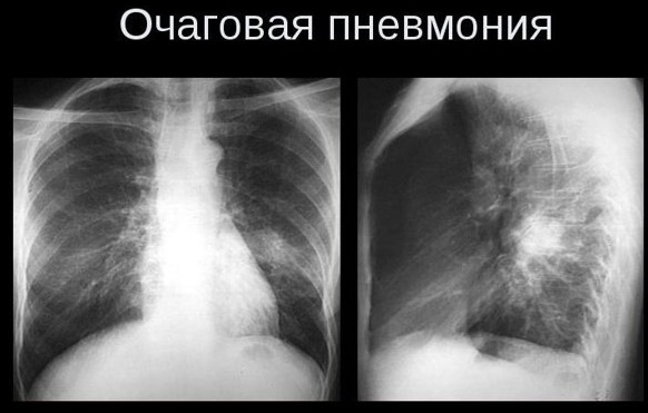 Рентгенография ОГК. Что это такое в 2-х проекциях, прямой проекции, подготовка, расшифровка, цена