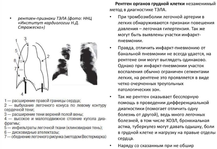 Рентгенография ОГК. Что это такое в 2-х проекциях, прямой проекции, подготовка, расшифровка, цена