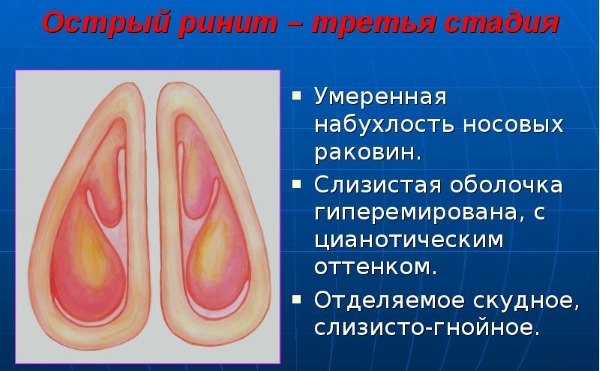 Ринофлуимуцил. Инструкция по применению для детей, с какого возраста. Отзывы, аналоги
