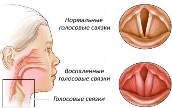 Ротокан для полоскания горла. Как разводить, инструкция по применению