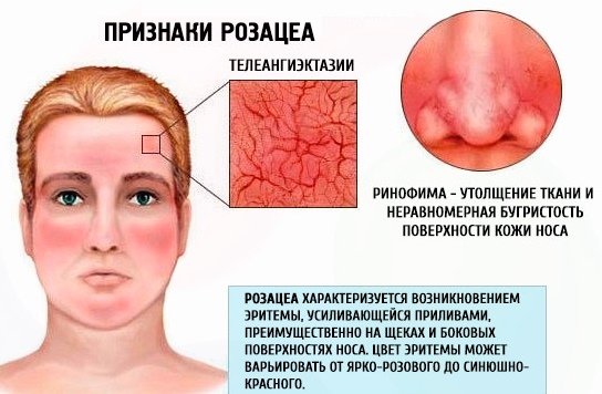 Солантра от розацеа. Инструкция по применению, цена, отзывы
