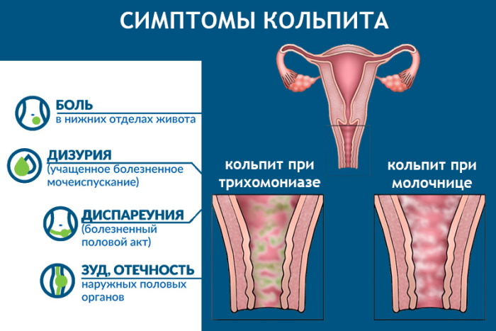 Острый вагинит. Что это, причины, симптомы, лечение