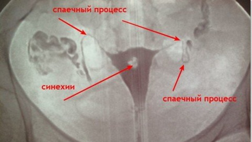 Сальпингоофорит. Симптомы и лечение у женщин. Препараты, народные средства