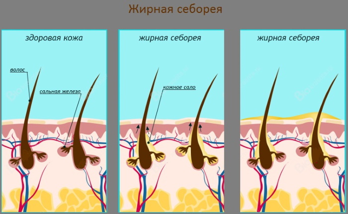 Себорея кожи лица, головы, тела. Причины, симптомы, фото и лечение