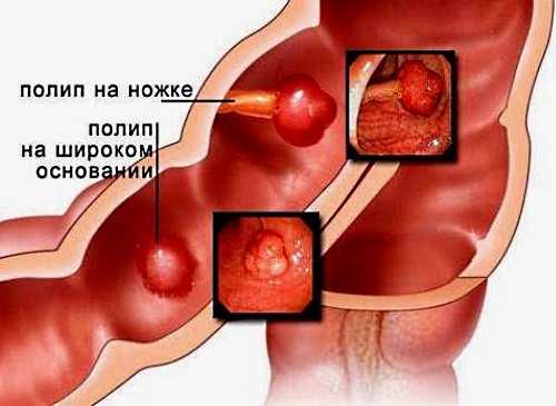 Сигмовидная кишка. Где находится и как болит, симптомы, заболевания, лечение и операция по удалению