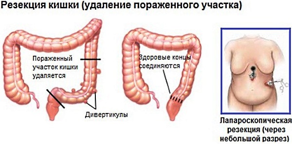 Сигмовидная кишка. Где находится и как болит, симптомы, заболевания, лечение и операция по удалению