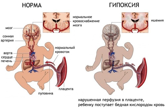 Мышечная дистония у грудничка, детей, взрослых. Что это такое, симптомы, лечение