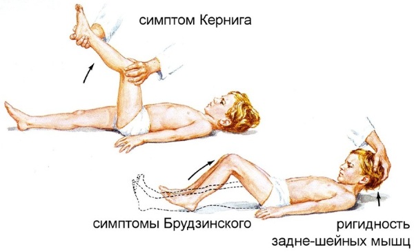 Симптом Кернига и Брудзинского при менингите, ОНМК, паркинсоне, инсульте. Что это такое, как проверить