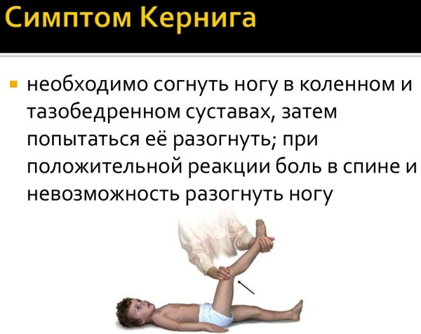 Симптом Кернига и Брудзинского при менингите, ОНМК, паркинсоне, инсульте. Что это такое, как проверить