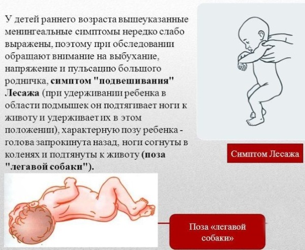 Симптом Кернига и Брудзинского при менингите, ОНМК, паркинсоне, инсульте. Что это такое, как проверить