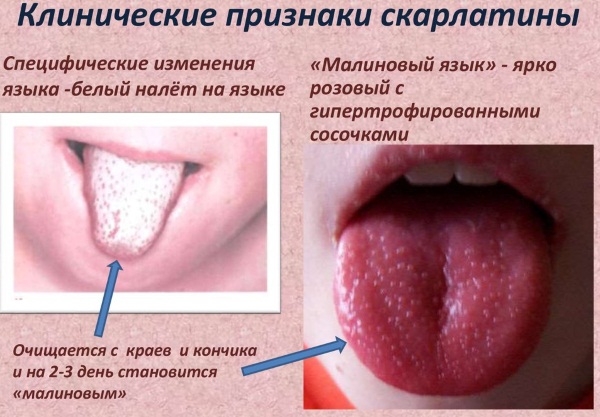 Симптомы и лечение скарлатины у детей, как выглядит горло, язык, сыпь. Стадии, профилактика, инкубационный период, последствия