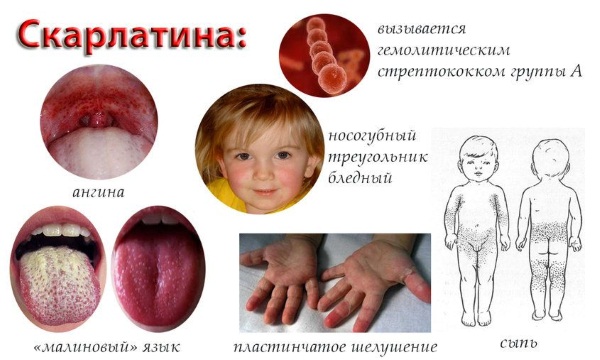 Симптомы и лечение скарлатины у детей, как выглядит горло, язык, сыпь. Стадии, профилактика, инкубационный период, последствия