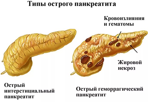 Симптомы заболеваний поджелудочной железы, воспаления. Лечение, диета