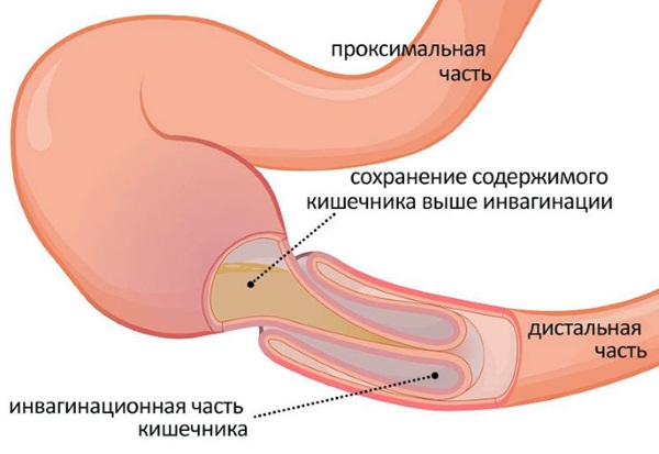 Симптомы заболеваний поджелудочной железы, воспаления. Лечение, диета