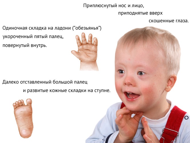Синдром Саванта. Что это такое, как получить, симптомы, признаки