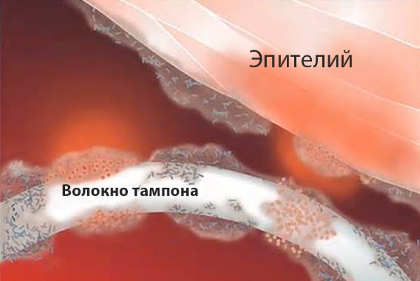 Синдром токсического шока (СТШ). Что это такое, симптомы, как избежать, лечить