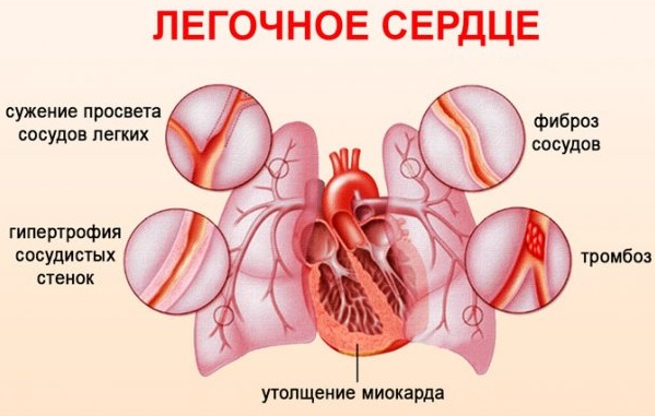 Синдромы при бронхиальной астме: ведущие основные, клинические у детей. Список