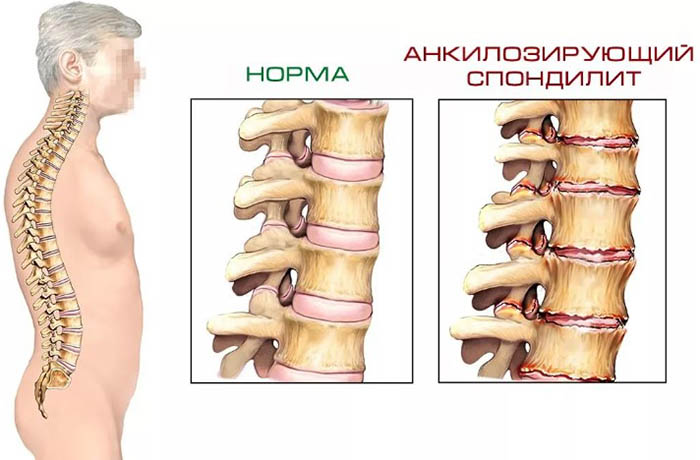 Спондилит. Что это такое воспаление поясничного отдела позвоночника, лечение