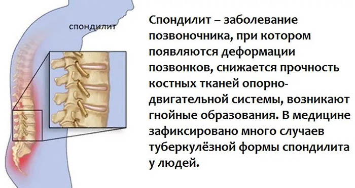 Спондилит. Что это такое воспаление поясничного отдела позвоночника, лечение