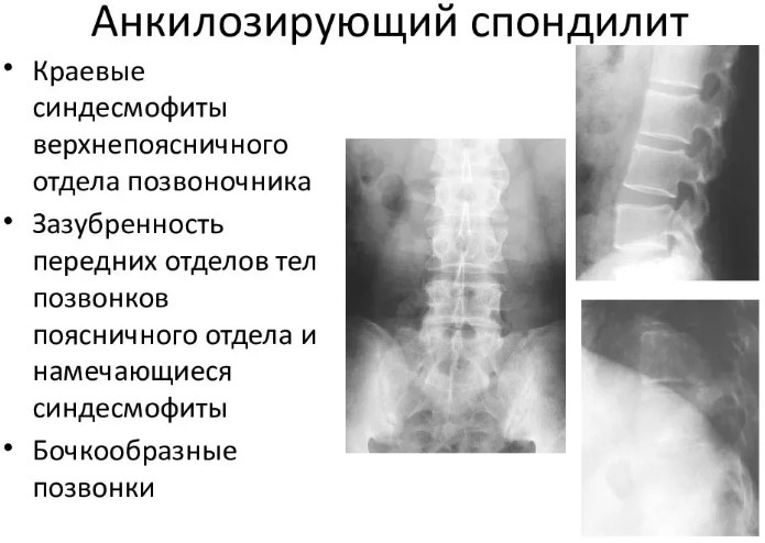 Спондилит. Что это такое воспаление поясничного отдела позвоночника, лечение