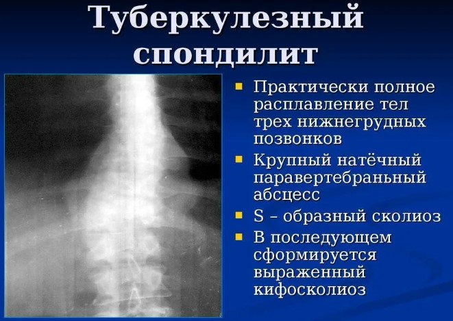 Спондилит. Что это такое воспаление поясничного отдела позвоночника, лечение