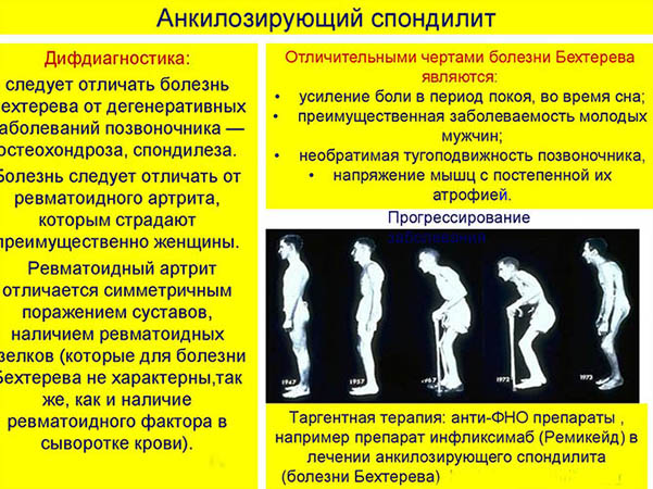 Спондилит. Что это такое воспаление поясничного отдела позвоночника, лечение