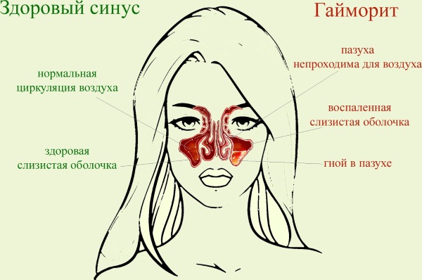 Цефотаксим (Cefotaxime) уколы. Цена, инструкция, как разводить для детей, взрослому, сколько колоть