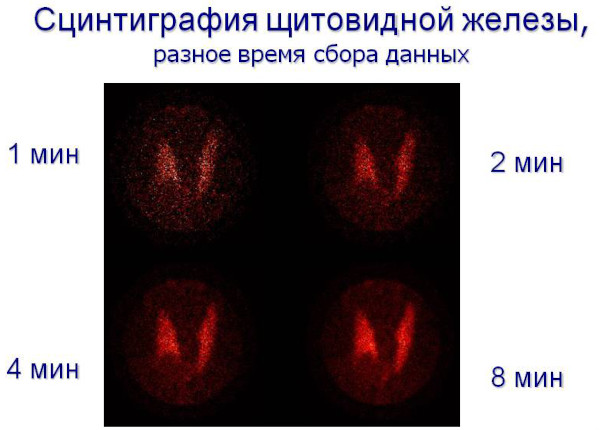 Сцинтиграфия щитовидной железы. Что это такое, цена