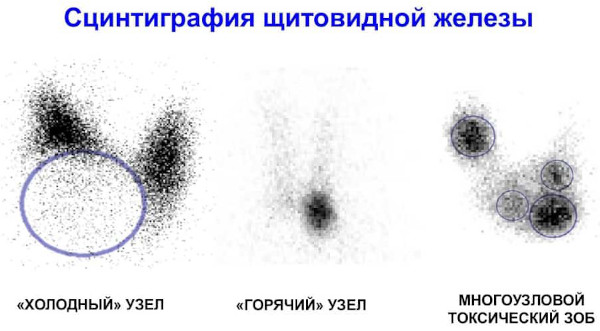 Сцинтиграфия щитовидной железы. Что это такое, цена