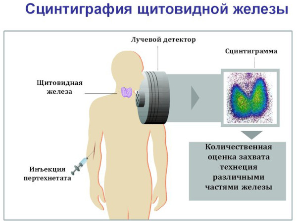 Сцинтиграфия щитовидной железы. Что это такое, цена