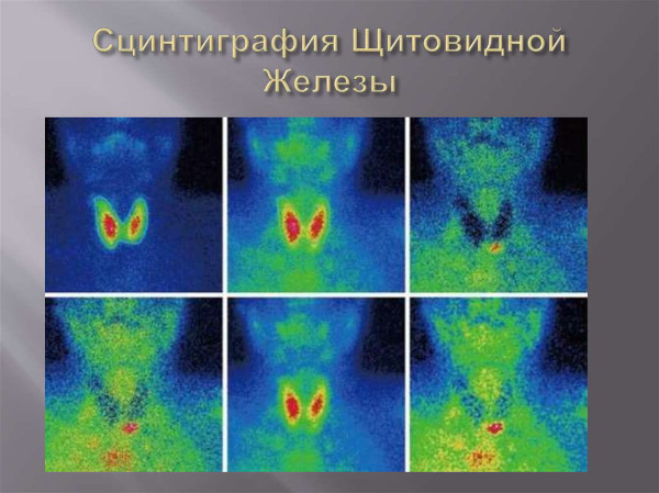 Сцинтиграфия щитовидной железы. Что это такое, цена