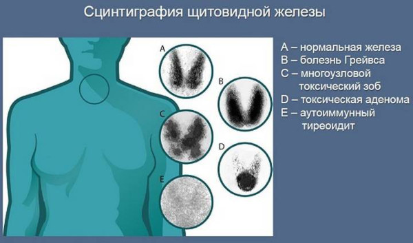 Сцинтиграфия щитовидной железы. Что это такое, цена