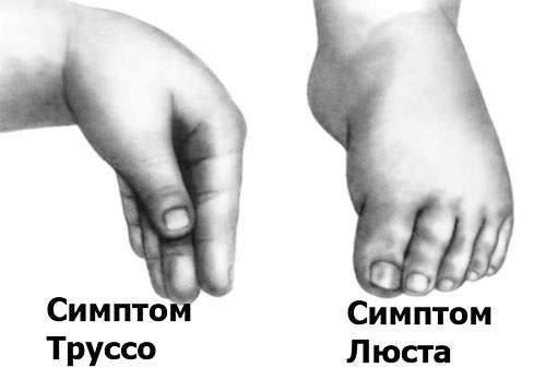 Судороги у детей при температуре. Причины, первая помощь, последствия спазмофилии, фебрильные