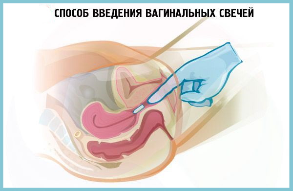 Свечи при бактериальном вагинозе. Лечение при беременности