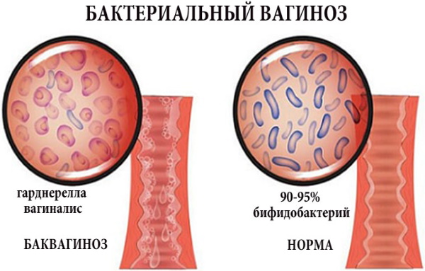 Свечи при бактериальном вагинозе. Лечение при беременности