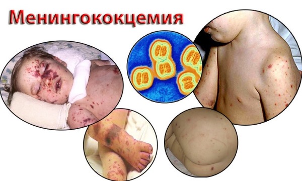 Сыпь на теле у ребенка. Фото с пояснениями: в виде прыщиков, мелкая, чешется, красная, без температуры, зуд, аллергическая. Что это может быть