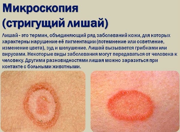 Сыпь на теле у ребенка. Фото с пояснениями: в виде прыщиков, мелкая, чешется, красная, без температуры, зуд, аллергическая. Что это может быть