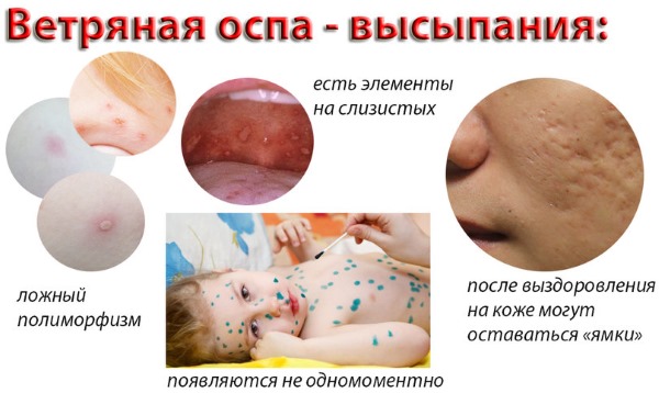Сыпь на теле у ребенка. Фото с пояснениями: в виде прыщиков, мелкая, чешется, красная, без температуры, зуд, аллергическая. Что это может быть