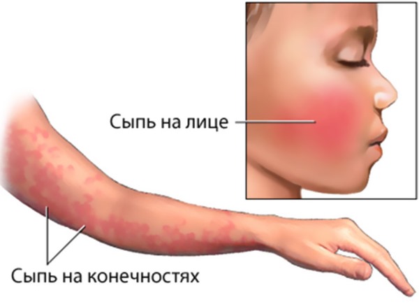 Сыпь на теле у ребенка. Фото с пояснениями: в виде прыщиков, мелкая, чешется, красная, без температуры, зуд, аллергическая. Что это может быть