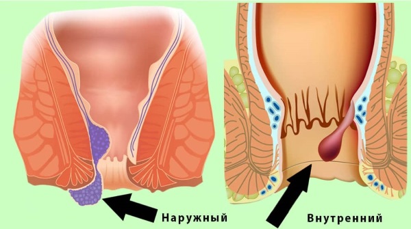 Таблетки от геморроя недорогие и эффективные, обезболивающие свечи. Цены, отзывы