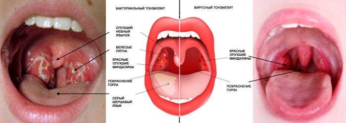 Таблетки от горла недорогие но эффективные для детей, взрослых, антибиотики. Цены, как принимать