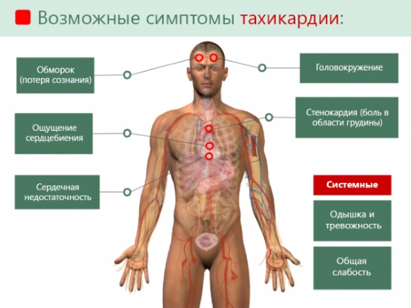 Синусовая тахикардия сердца. Что это такое, симптомы, как лечить у женщин, детей