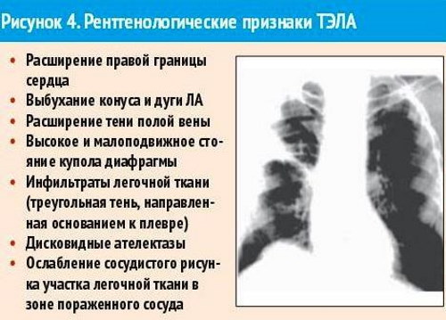 ТЭЛА на ЭКГ. Признаки, фото, что это, лечение